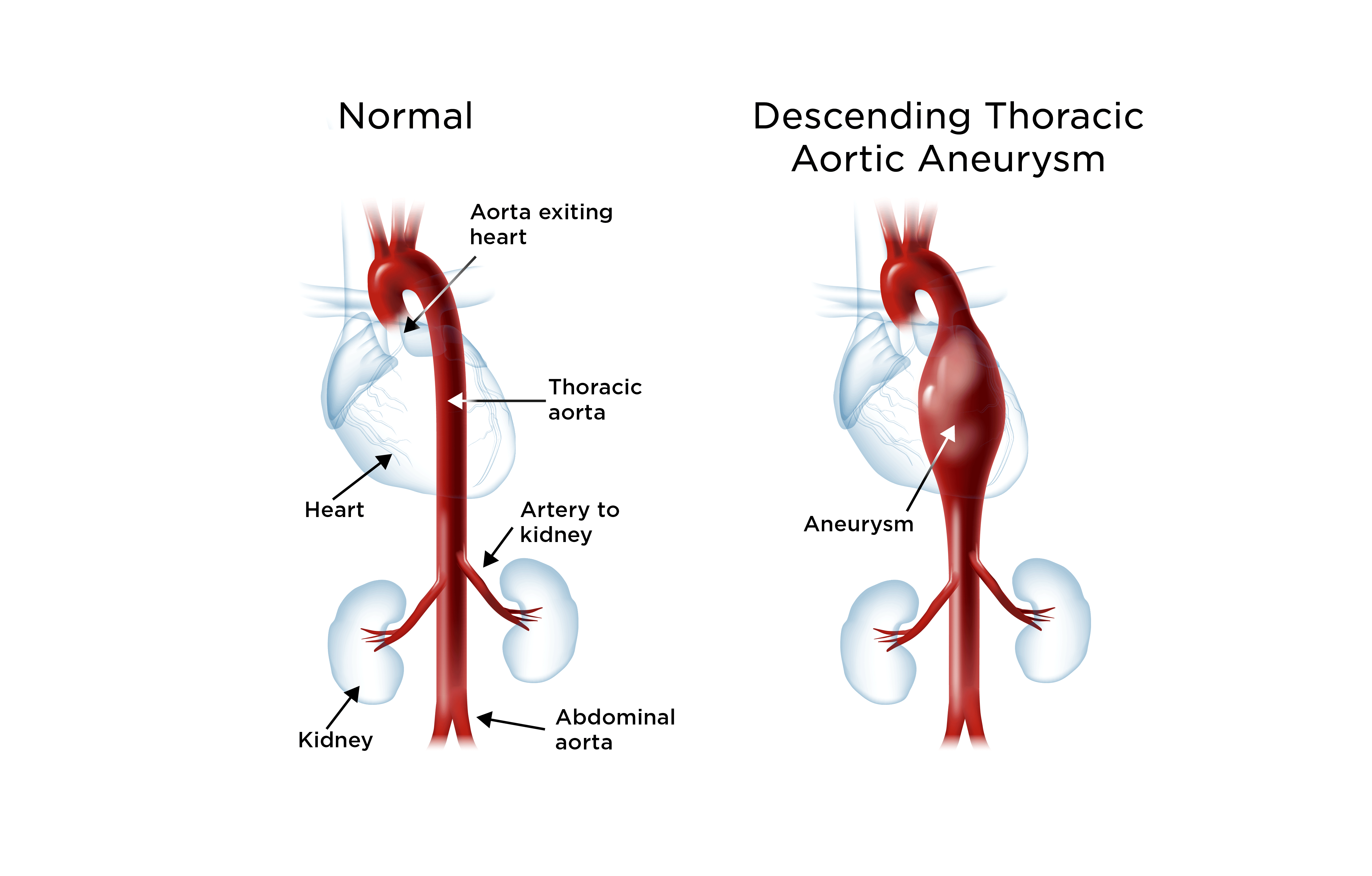 Ascending And Descending Aorta