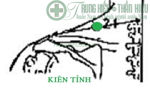 Huyệt kiên tỉnh