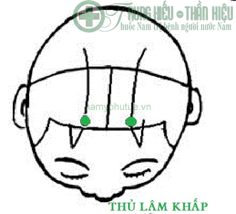 Huyệt đầu lâm khấp