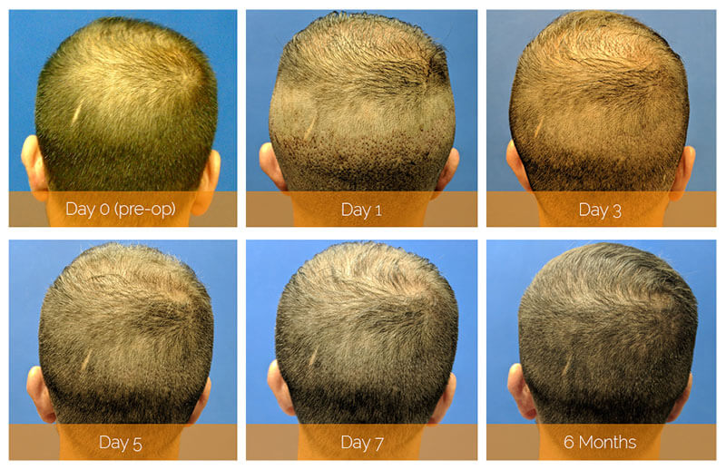 Hair Restoration Recovery