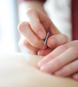 acupuncture practitioner inserting needle into skin