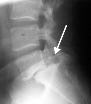 Pars Fracture Lumbar Spine