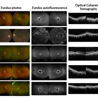 Ophthalmic images from the study probands exhibit variable forms of retinal dystrophy as shown on fundus photos, fundus autoflorescence and optical coherence tomography.