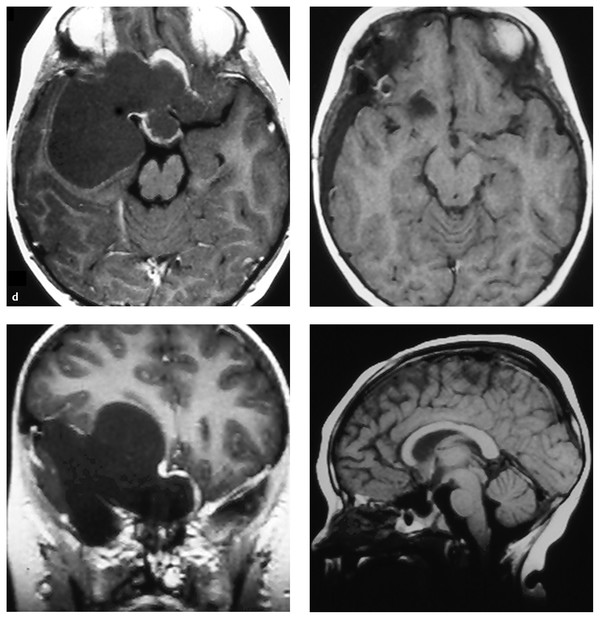 Craniopharyngiomas | Neupsy Key