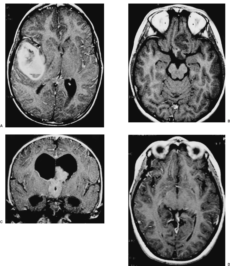 Supratentorial Hemispheric Tumors | Neupsy Key