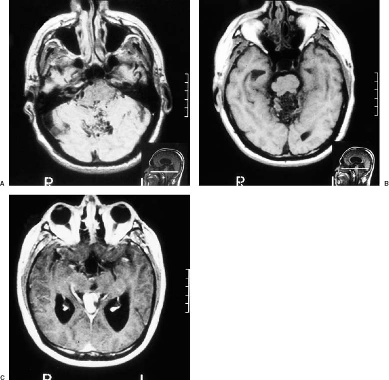 27 Retrograde Venous Thrombosis after Excision of a Cerebral ...