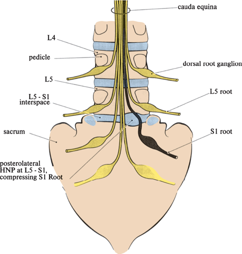 Neck and Back Pain | Neupsy Key