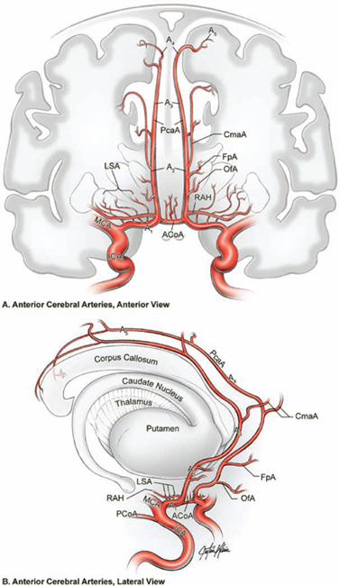 Anterior Communicating Artery Aneurysms | Neupsy Key