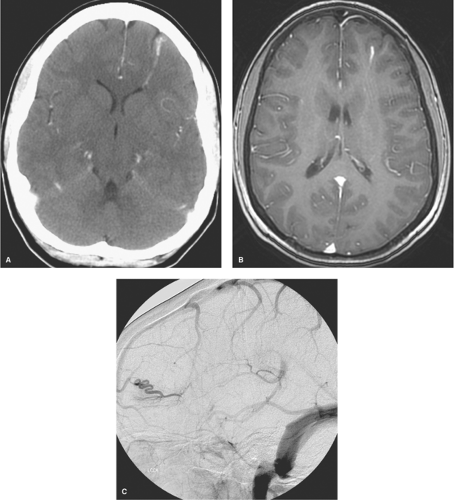 Vascular Malformations of the Brain | Neupsy Key