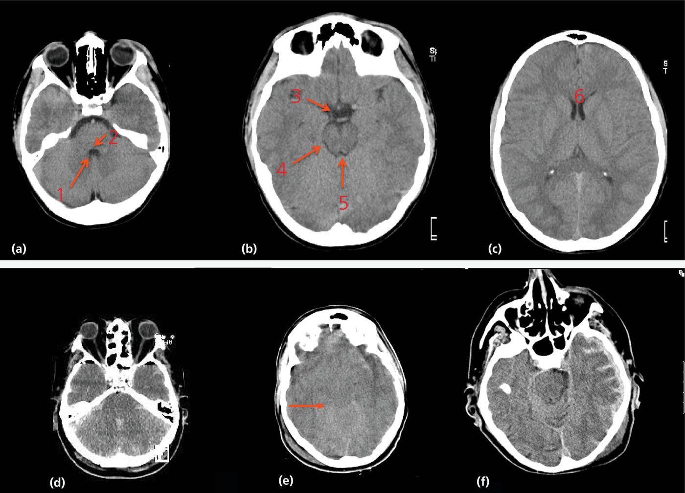 Understanding Brain Scans For Trauma: A 2024 Guide