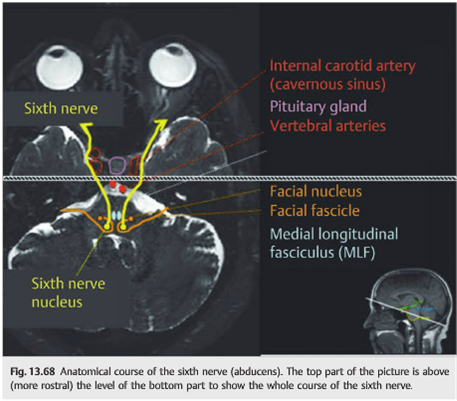 Cranial Nerve 6 Palsy