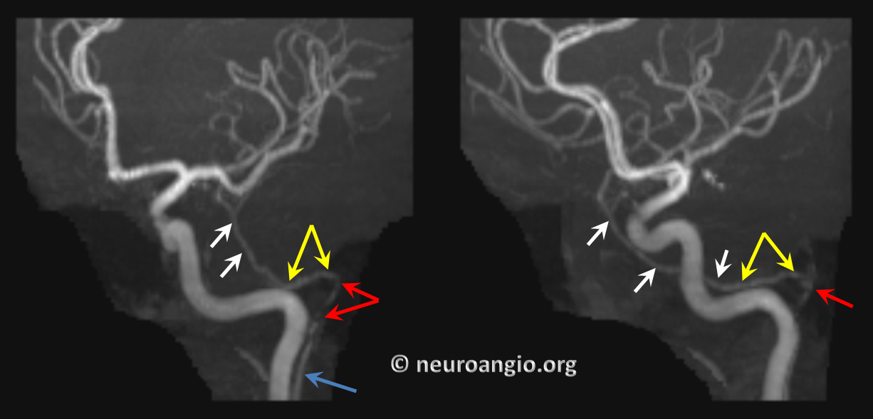 https://neuroangio.org/wp-content/uploads/AP/AP_Stapedial_Artery_MRI_1.png