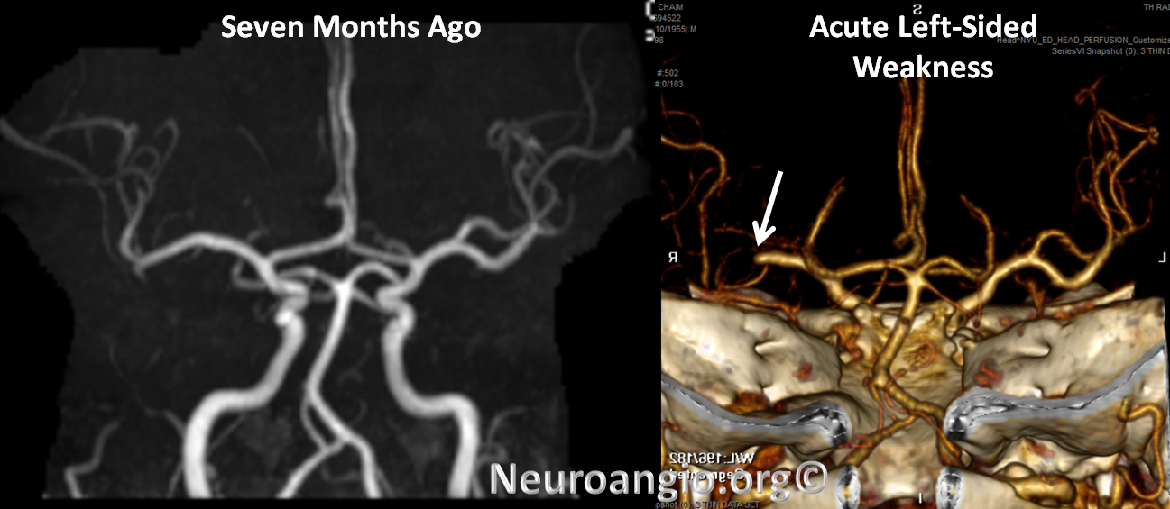 https://neuroangio.org/wp-content/uploads/Perfusion/Perfusion_23.png