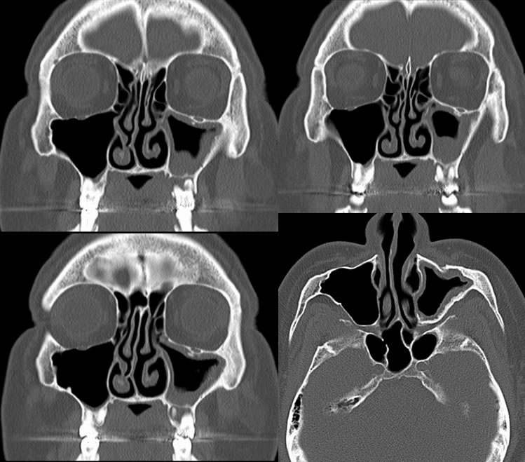 Right Maxillary Sinusitis Cheap Sellers, Save 57% | jlcatj.gob.mx