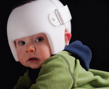 Infant with cranial molding helmet