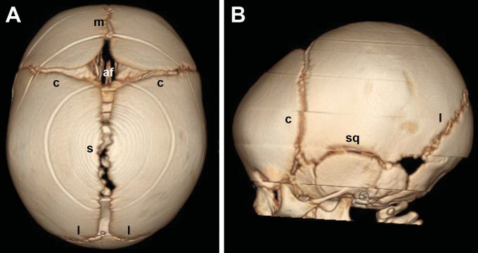 Normal infant skull