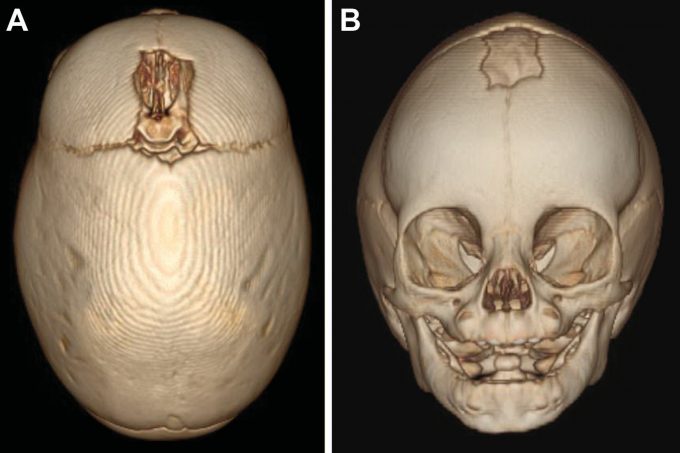 Example image of skull with sagittal craniosynostosis