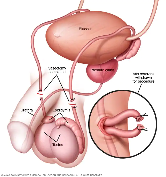 Vasectomy: Myths and Misconceptions