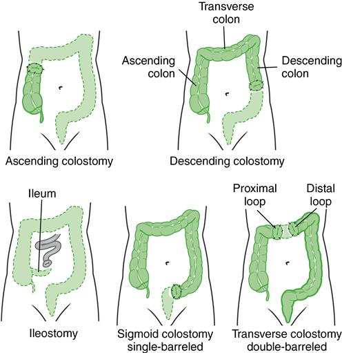 Transverse Colostomy