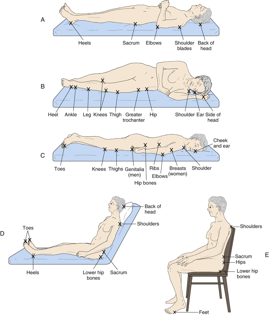 Pressure Ulcer Sites Diagram