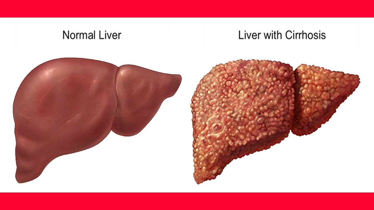 Nursing Interventions for Liver CirrhosisNursing File | Nursing File