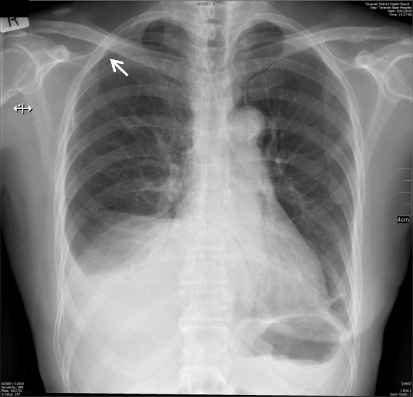 Empyema following laparoscopic appendicectomy—was peritoneal lavage to ...