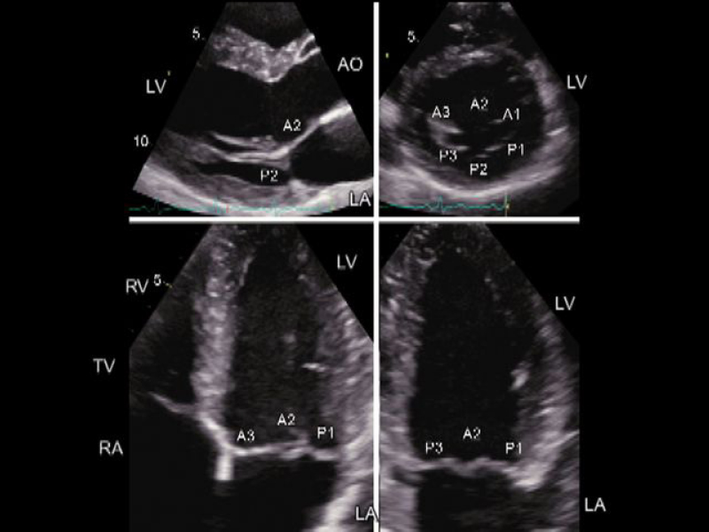 Mitral Valve Prolapse Echocardiogram