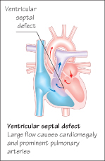 Heart murmurs | Obgyn Key