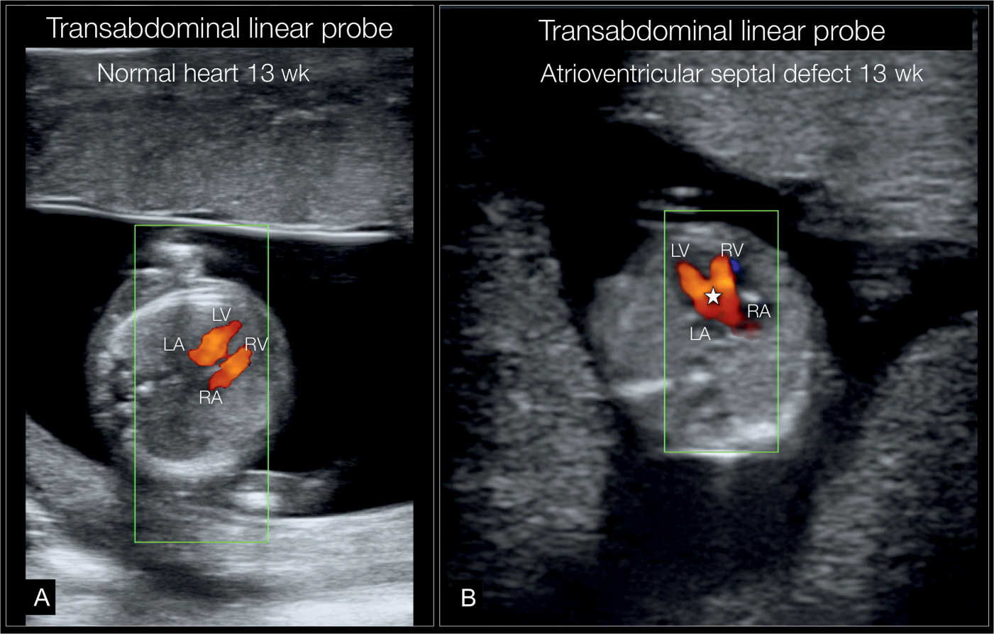 Why Fetal Heart Ultrasound Fetal Heart Ultrasound How Why And When | My ...