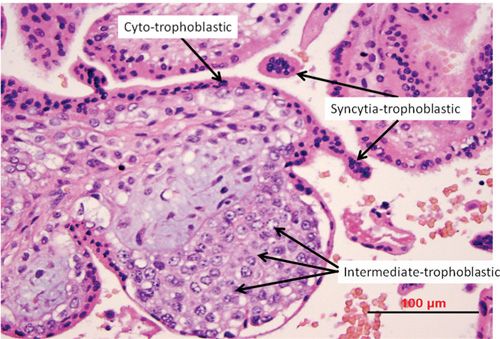 Gestational Trophoblastic Disease: Molar Pregnancy and Gestational ...