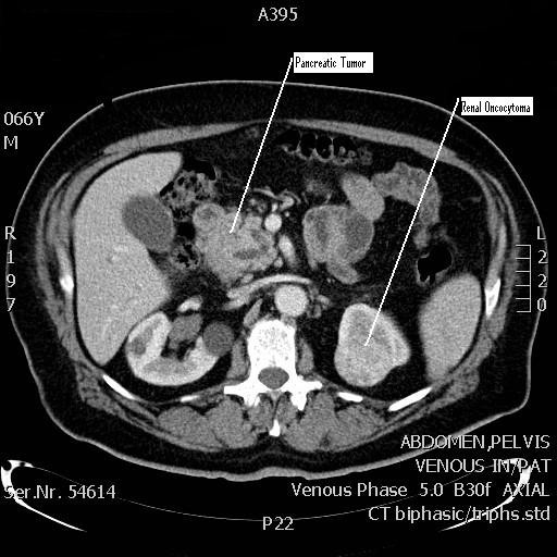 Ct Scan Of The Abdomen Showing The Pancreatic Tumor And Open I | My XXX ...