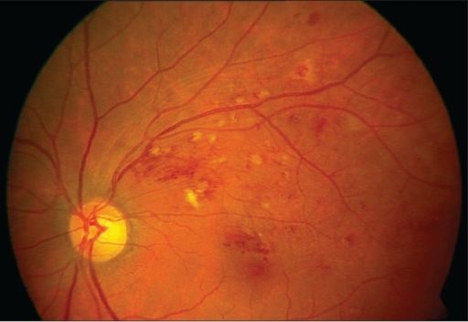 Fundus photograph showing partial resolution of branch | Open-i