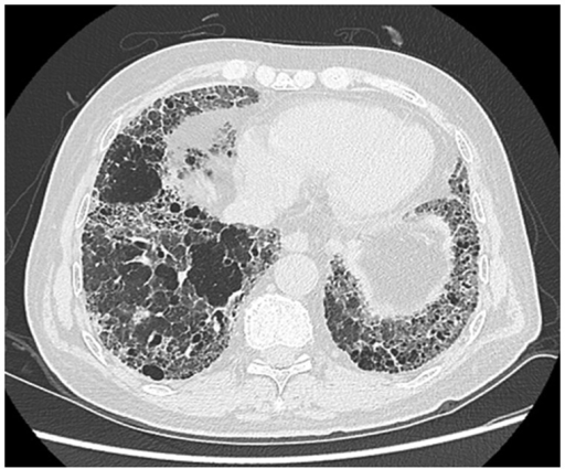 Diffuse interstitial lung disease - Pictures