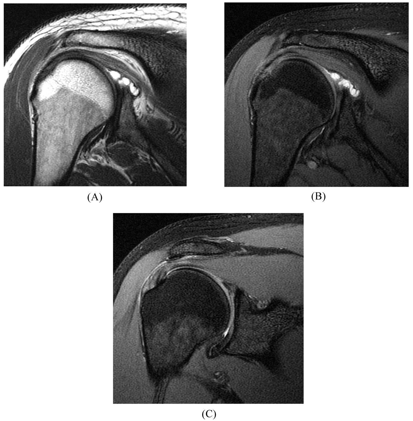 Labrum Tear Mri