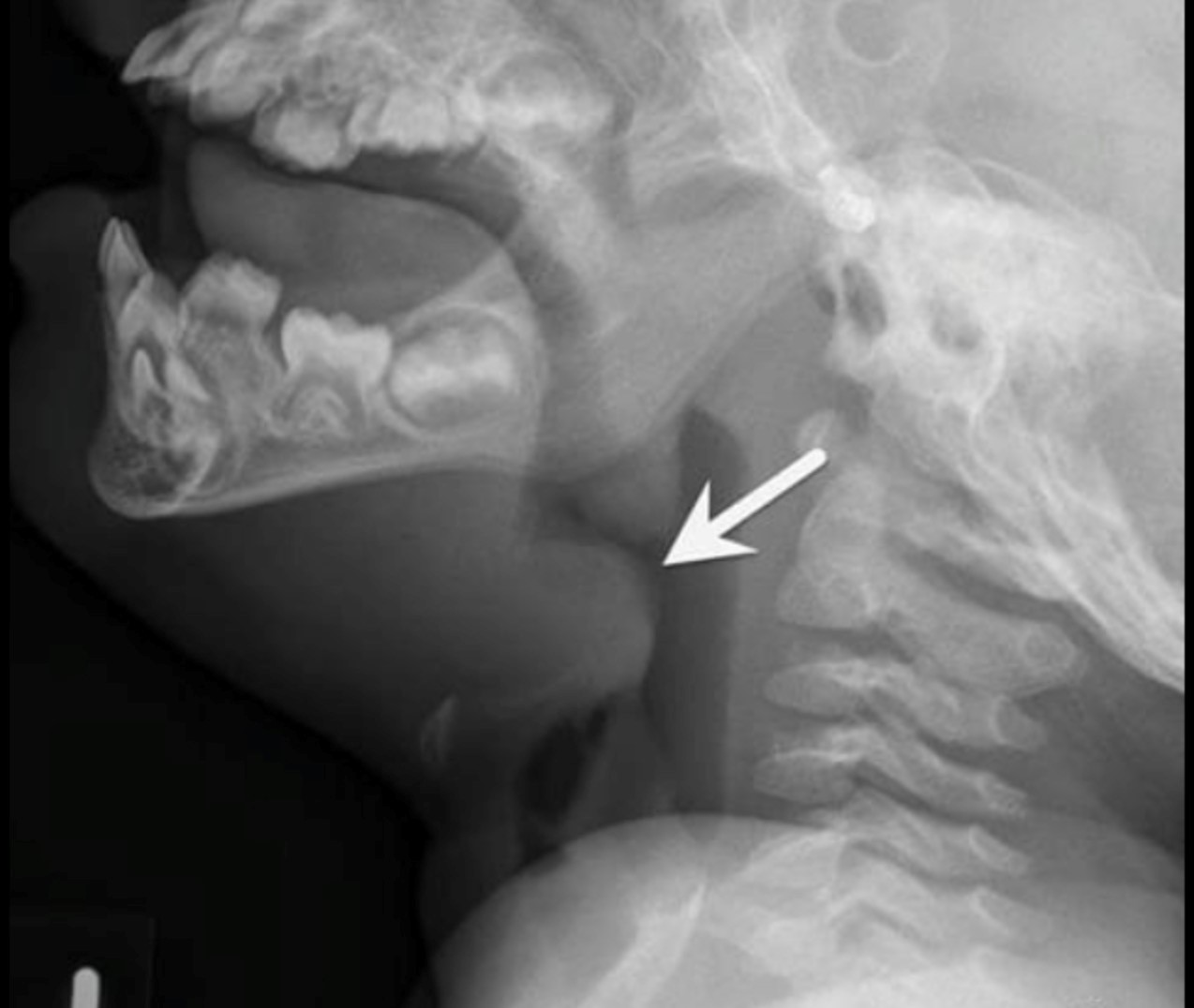 Swollen Epiglottis