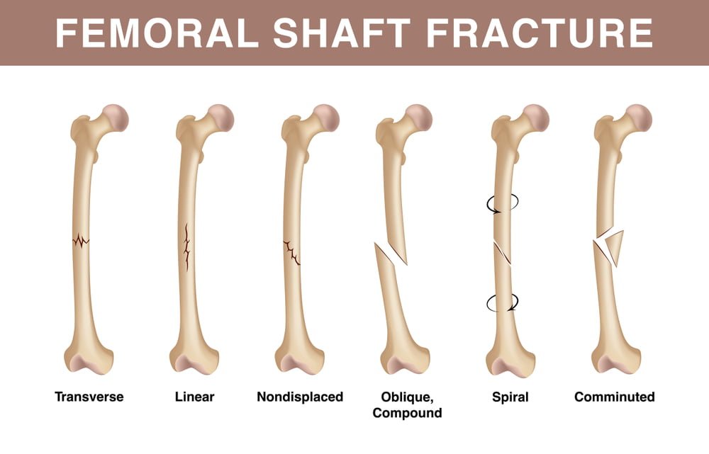 Proximal Femoral Fractures and Implants- an Ultimate Guide