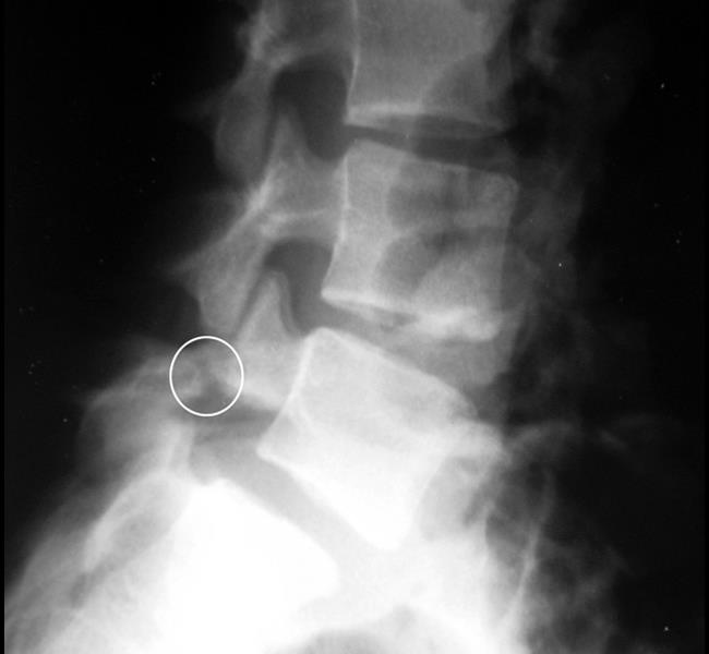 Spondylolysis and Spondylolisthesis – Dr Mukhi's Raj Hospital