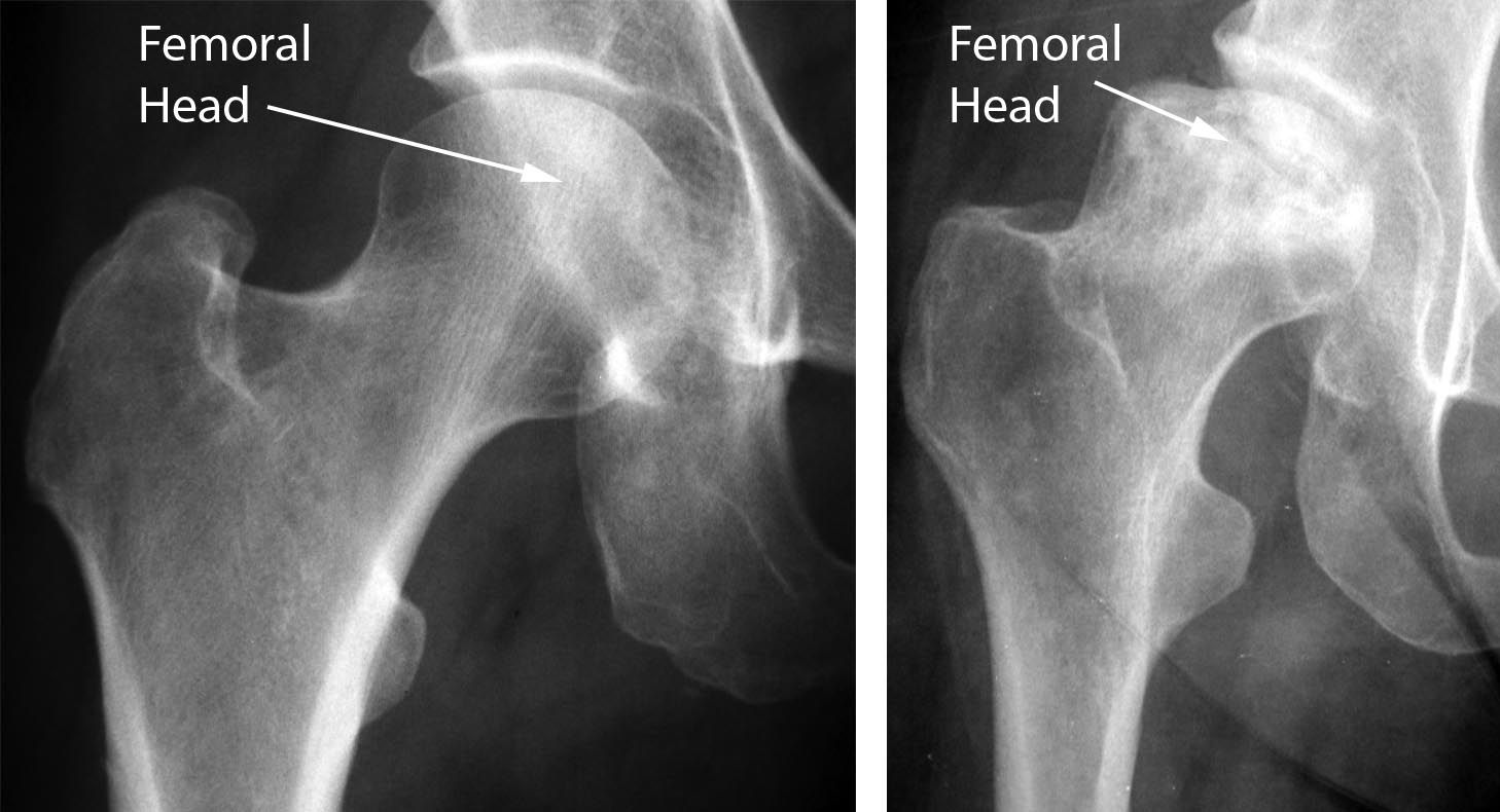 Osteonecrosis of the Hip - OrthoInfo - AAOS