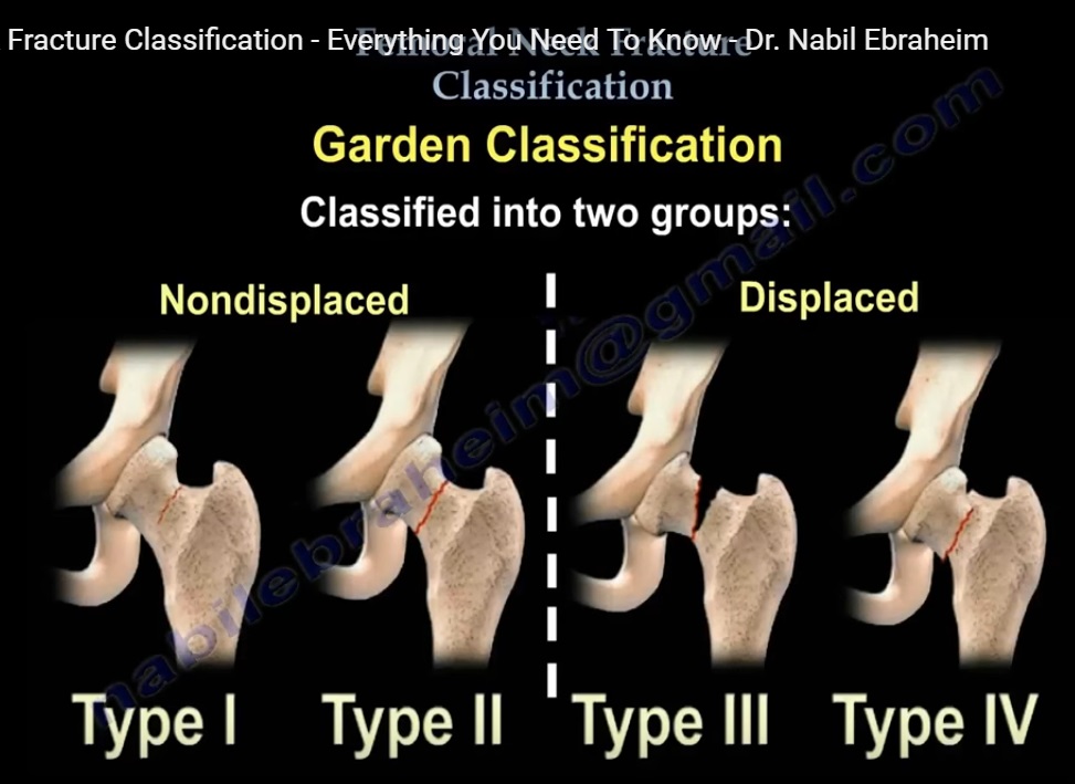 Garden Classification Of Hip Fractures ️ Descubra as emoções do jogo ...