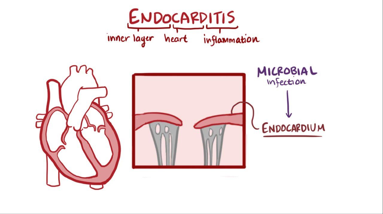 Endocarditis Ecg