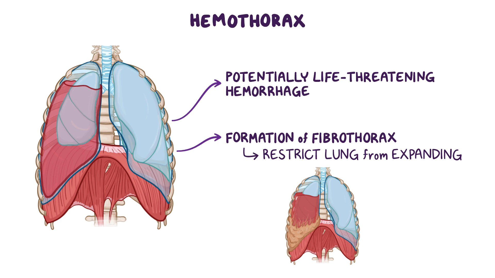 Hemothorax: Clinical sciences - Osmosis Video Library