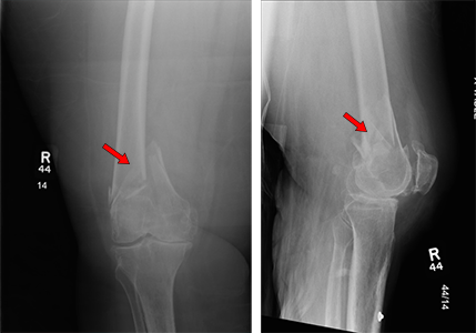 Compression Fracture X Ray Femur