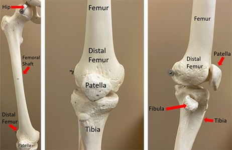 Distal Femoral Fracture