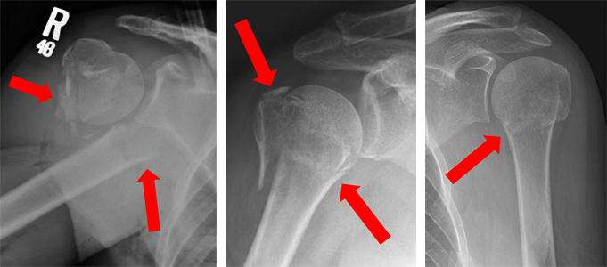 Mechanisms Of Humeral Head Fracture