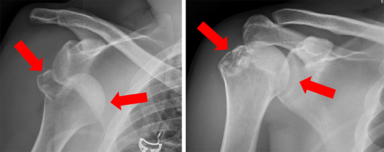 Shoulder Dislocation With Fracture Orthopaedic Trauma Association Ota ...