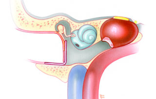 Coronal schematic view of the bone removed during the hypotympanic-subcochlear approach to the petrous apex. Note that the floor of the ear canal and hypotympanum has been removed to the level of the jugular bulb. Superiorly, the opening is bounded by the cochlea. More medially, the opening courses over the genu of the carotid artery. As shown here, the hypotympanic defect is enclosed with a fascia graft, resulting in a larger than normal tympanic membrane.