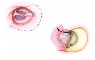 The superiorly based tympanomeatal flap employed in the subcochlear approach to the petrous apex is designed to provide wide exposure of the hypotympanic region.