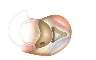 Bony removal is commenced in the hypotympanic region. For orientation, it is usually best to identify the walls of both the jugular and carotid. This can be safely accomplished working gently with a diamond burr. The wall of the cholesterol granuloma is often fairly robust and may need to be opened sharply. When in doubt, aspiration with a needle may help confirm the identity of the cyst wall prior to its incision. Image guidance could also be helpful in verifying cyst location. The window created into the cyst should be as large as possible. To evacuate as much cyst contents as possible, the cyst cavity should be copiously lavaged with bacitracin saline through a plastic tube (e.g., no. 14 Angiocath). The passageway to the apex is usually sufficiently large to remain open by itself. When the connection is fairly small, a rolled sheet of thin silicon rubber (0.005 inch) is placed through the opening to discourage the formation of webs. A rolled sheet is better than a length of catheter, as it expands and accommodates to the maximal diameter of the opening. A fraction of surgically created apex drainage tracts close over time.