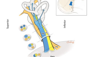 Anatomy of the nerves traversing the internal auditory canal as seen from a retrosigmoid craniotomy perspective. Note the 90-degree rotation of the vestibular and cochlear nerve components of the eighth nerve between inner ear and brainstem entry. C, cochlear nerve; CN, cochlear nerve; IV, inferior vestibular nerve; VN, vestibular nerve; SV, superior vestibular nerve; 7, facial nerve.