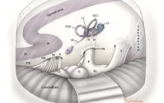 Anatomical relationships of the cerebellopontine as seen through a retrosigmoid posterior fossa craniotomy. JV, jugular vein; JB, jugular bulb; SS, sigmoid sinus; 11s, spinal component of the accessory nerve; 11c, cranial component of the accessory nerve; 10, vagus nerve; 9, glossopharyngeal nerve; Ch, choroid plexus emanating from the lateral recess to the fourth ventricle; Fl, flocculus; BS, brainstem surface (pons); 7, facial nerve; 8, audiovestibular nerve; 5, trigeminal nerve; PA, porus acusticus; IV, inferior vestibular nerve; SV, superior vestibular nerve; ES, endolymphatic sac; VA, vestibular aqueduct; PSCC, posterior semicircular canal; CC, common crus; SSCC, superior semicircular canal; Co, cochlea.